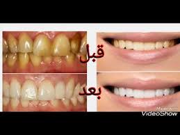 Blanchisseur De Dents Miracle مبيض الأسنان